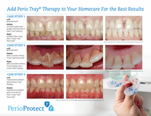 Perio Protect® Method® Patient Education Brochure