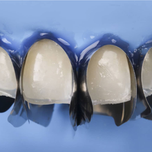 Unica Minideep Anterior Matrices Matrix Systems