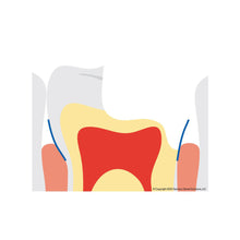 ReelMatrix™ Deep Margin Elevation Kit by Garrison Dental, Reelmatrix Diagram