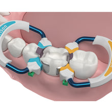 Strata-G™ Matrix Rings - Nitinol Wire for Durability & Strength, Blue Ring & Orange Ring Placement
