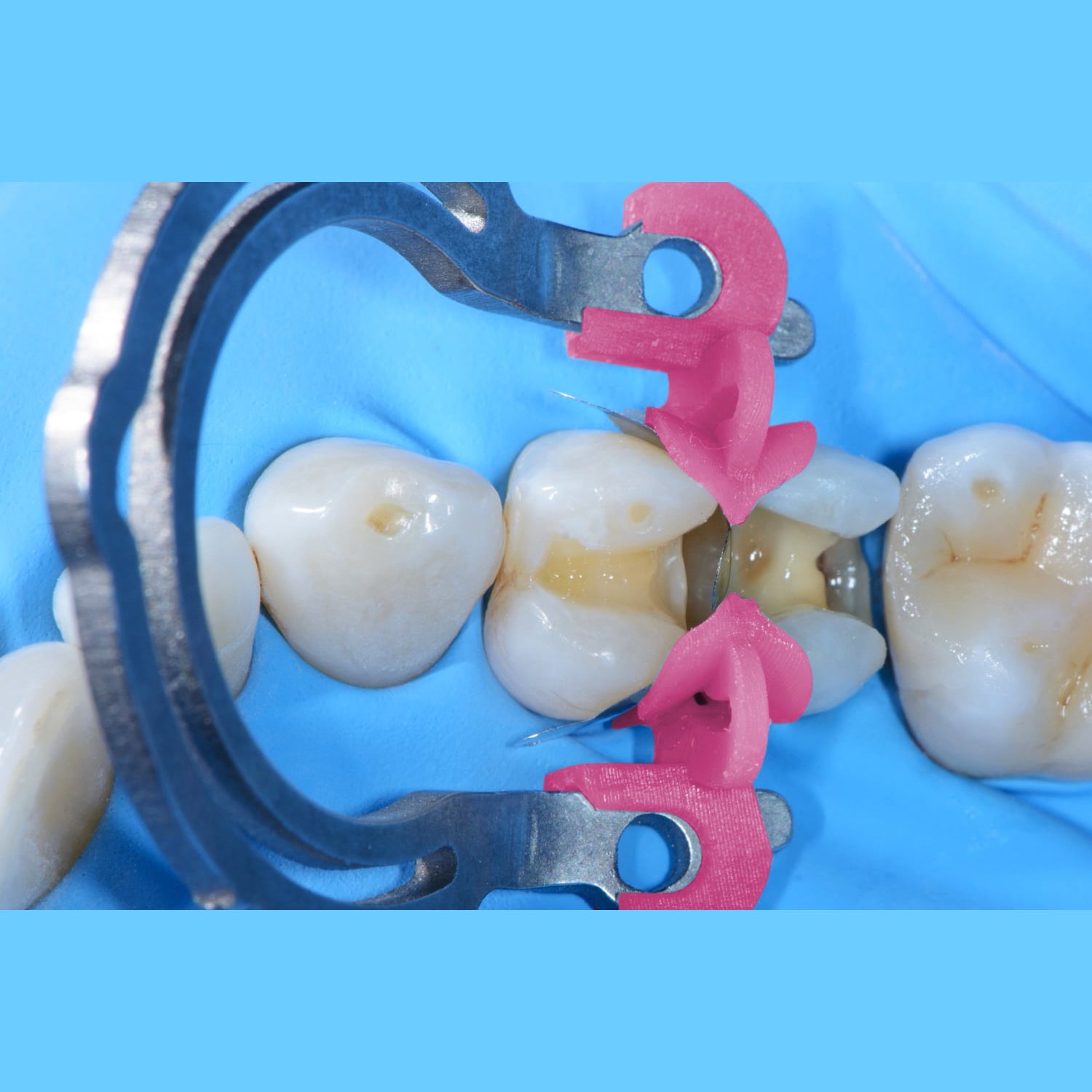 Quickmat Prime by Polydentia sectional matrix system with integrated wedges for Class II restorations. Curion Dental 