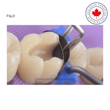 LM-Arte™ Misura Posterior | Curion Dental