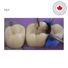 LM-Arte™ Misura Posterior | Curion Dental