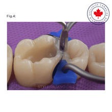 LM-Arte™ Misura Posterior | Curion Dental