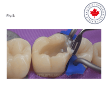 LM-Arte™ Misura Posterior | Curion Dental